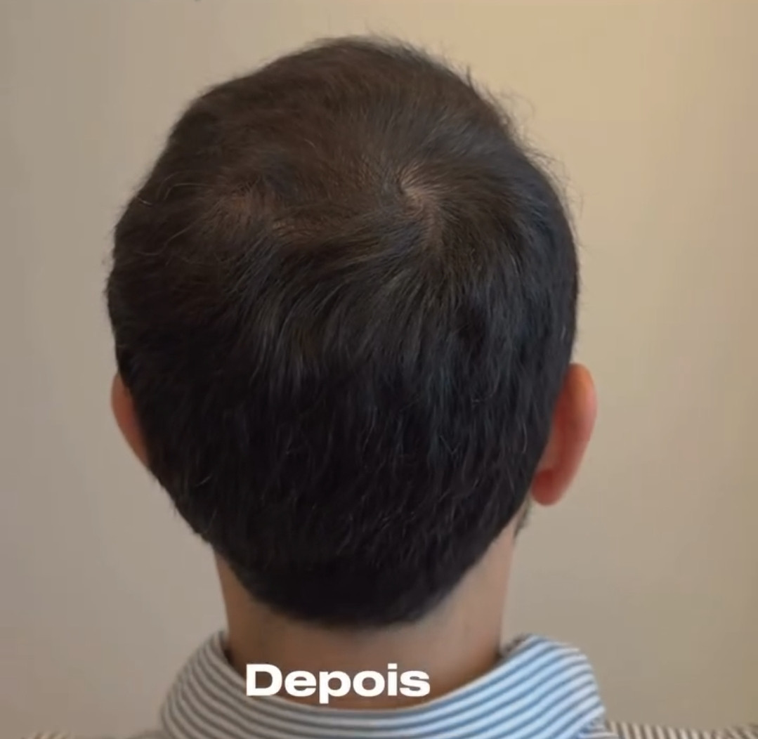 Antes e depois da terapia regenerativa 4