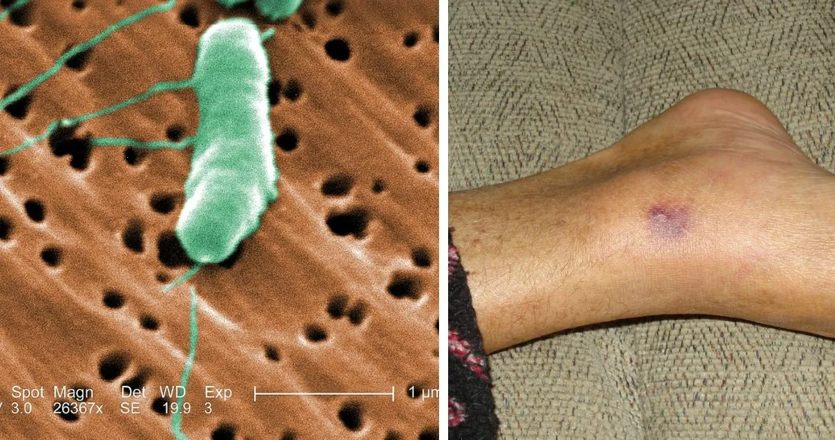 ¿Qué es y cómo se extendió rápidamente la bacteria carnívora en Japón?