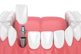 Standard vs. Immediate Loading: A Literature Review on How Long After Dental Implants Can I Eat Normally