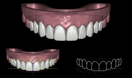 Coroas sobre Implante
