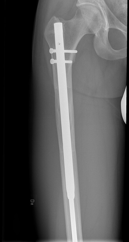 Surgeons who are CAREFUL about the length of their screws?