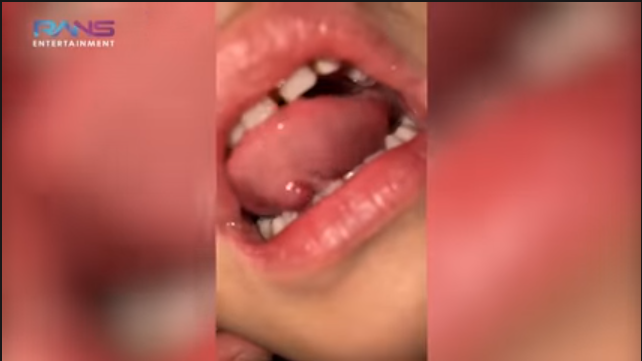 Benjolan di bawah lidah Rafathar
