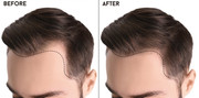 hair transplant in Dubai