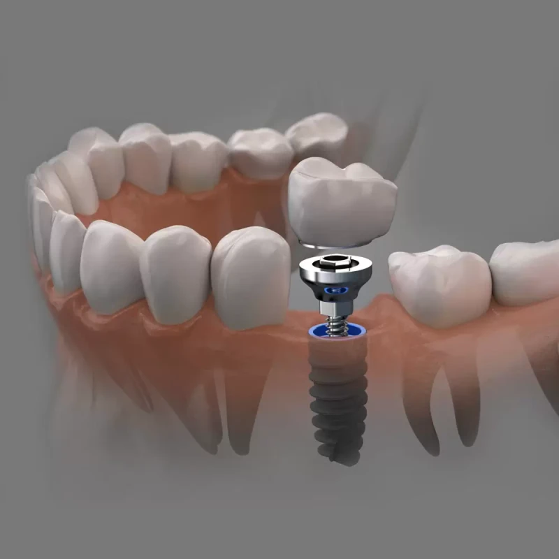 Why Missing Teeth Replacement Becomes a Mechanical Necessity