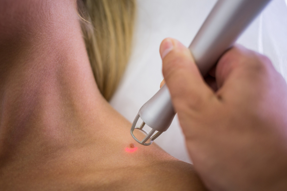 Tattoo Removal Preston