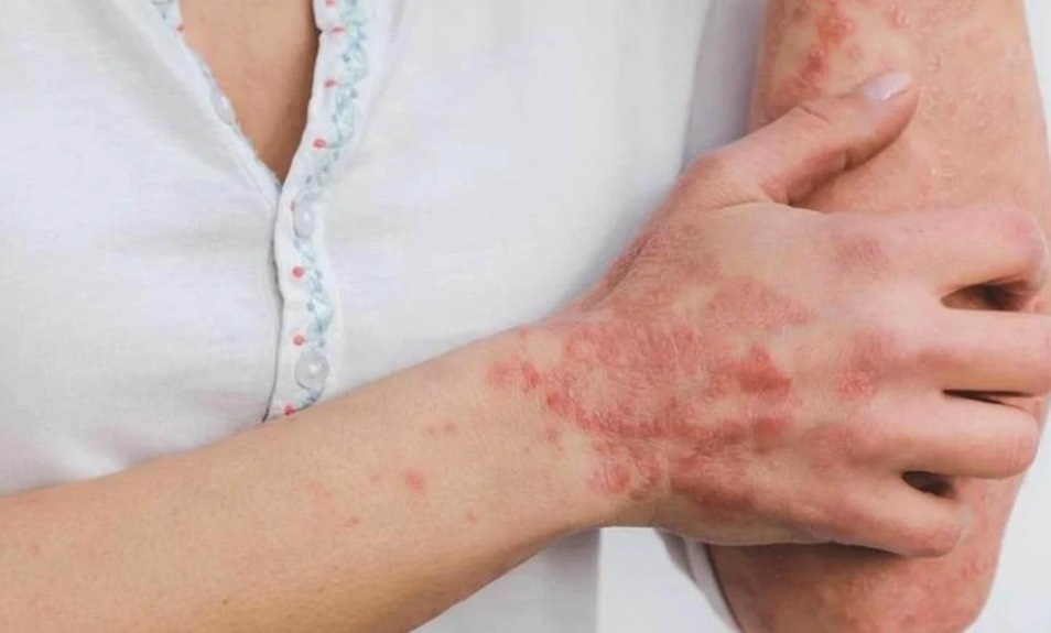 Estados Unidos confirma primer caso de viruela del mono