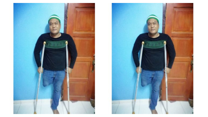 Pria ini harus rela kehilangan kaki kananya akibat kelalaian pihak rumah sakit