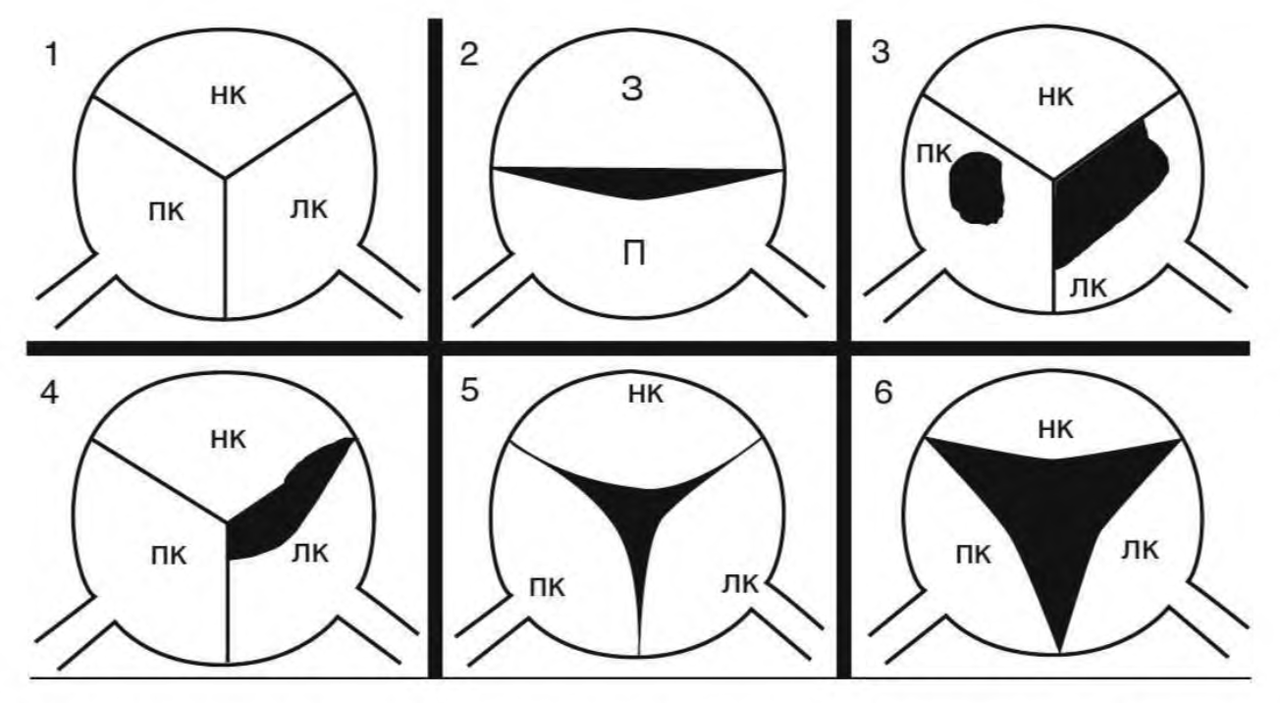 Схема поражения створок при различных заболеваниях, вызывающих аортальную регургитацию.<br>1 — нормальный трёхстворчатый клапан<br>(НК — некоронарная; ПК — правая коронарная; ЛК — левая коронарная).<br>2 — двухстворчатый клапан (П — передняя; З — задняя створки).<br>3 — изменения при инфекционном эндокардите.<br>4 — при ревматической лихорадке.<br>5 — при артериальной гипертензии.<br>6 — при синдроме Марфана.