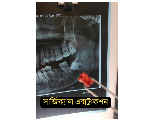 ৮ নং দাঁত মাইনর সার্জারি