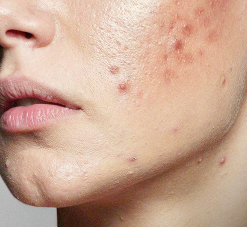 Post-Acne Marks