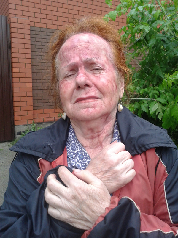 Ожег кислотой 1