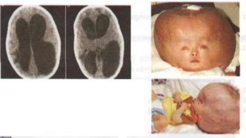 Congenital hydrocephalus - macrocephaly, tense fontanel, splayed sutures, prominent scalp veins
