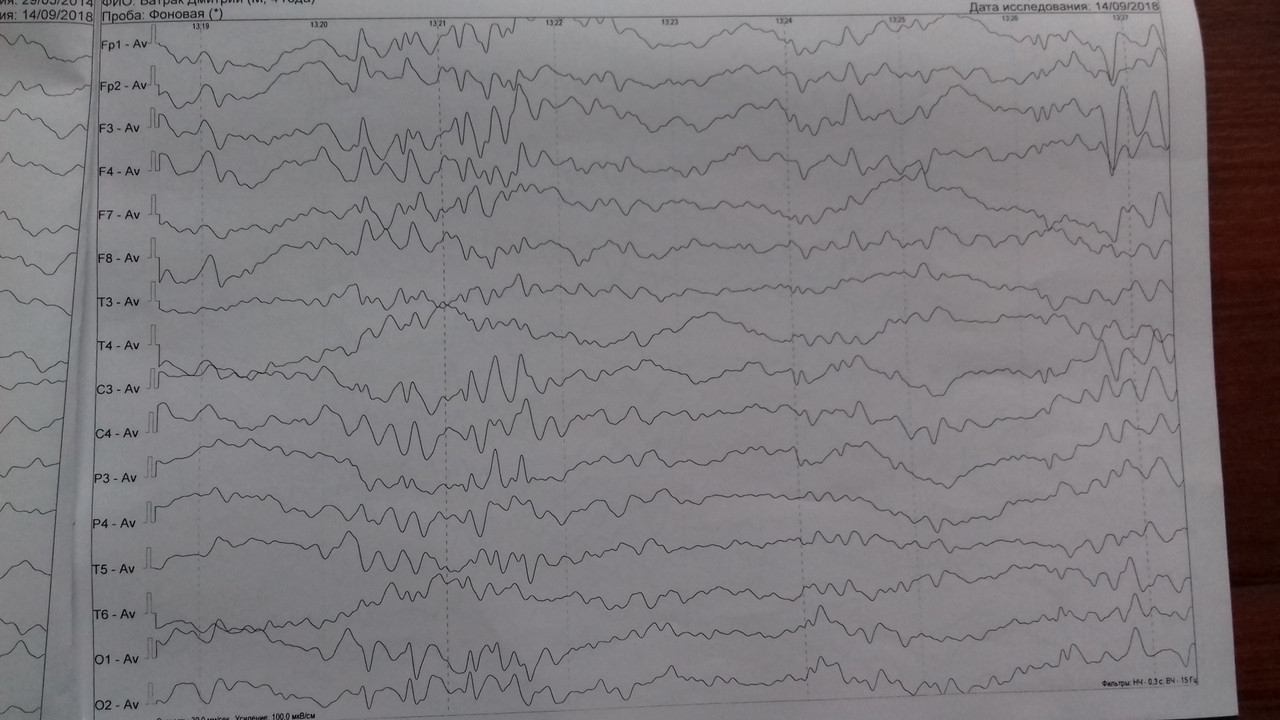 Нормы ЭЭГ эпиактивность. Атлас ЭЭГ Мухин. Полифазные волны на ЭЭГ. Полифазные потенциалы на ЭЭГ У детей. Ээг тверь