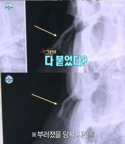 Hidung Han Hye Jin sebelum dan sesudah sembuh
Han Hye Jin.
