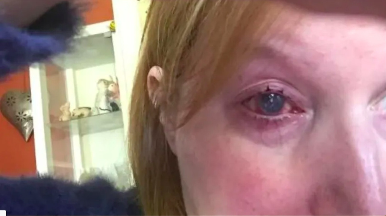 Mujer pierde el ojo tras contraer una infección cuando se bañaba