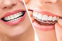 Invisalign Braces in Bangalore: Invisible. Comfortable. Effective.