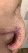 ftm penis 2