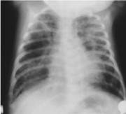 Chest X-ray of an infant with bronchopulmonary dysplasia showing hyperinflation, coarse interstitial markings, and cystic changes