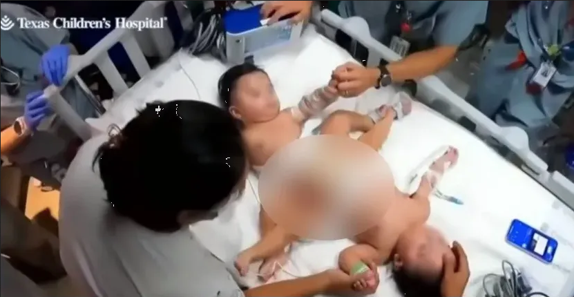 Siameses latinos sobreviven exitosamente luego de su separación quirúrgica