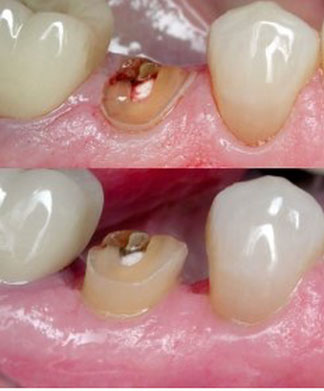Crown Lengthening