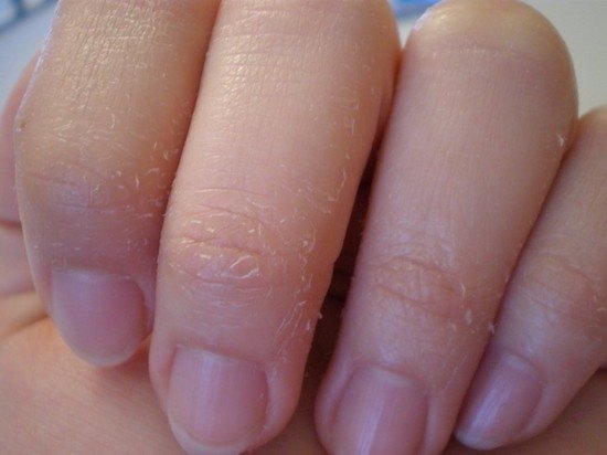 От чего шелушится кожа на пальцах рук. Устранение причин шелушения кожи