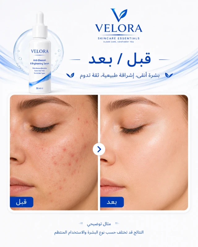 مثال قبل وبعد استخدام سيروم VELORA