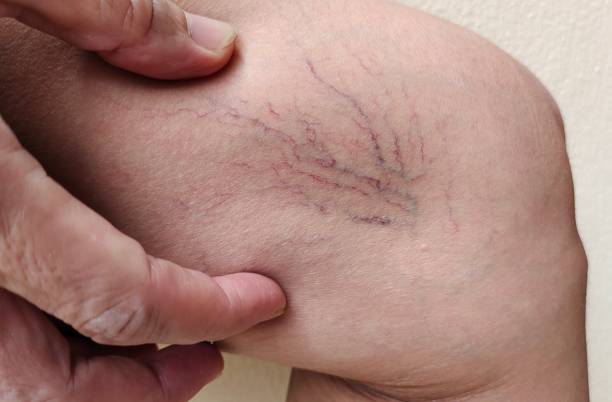 varicose veins