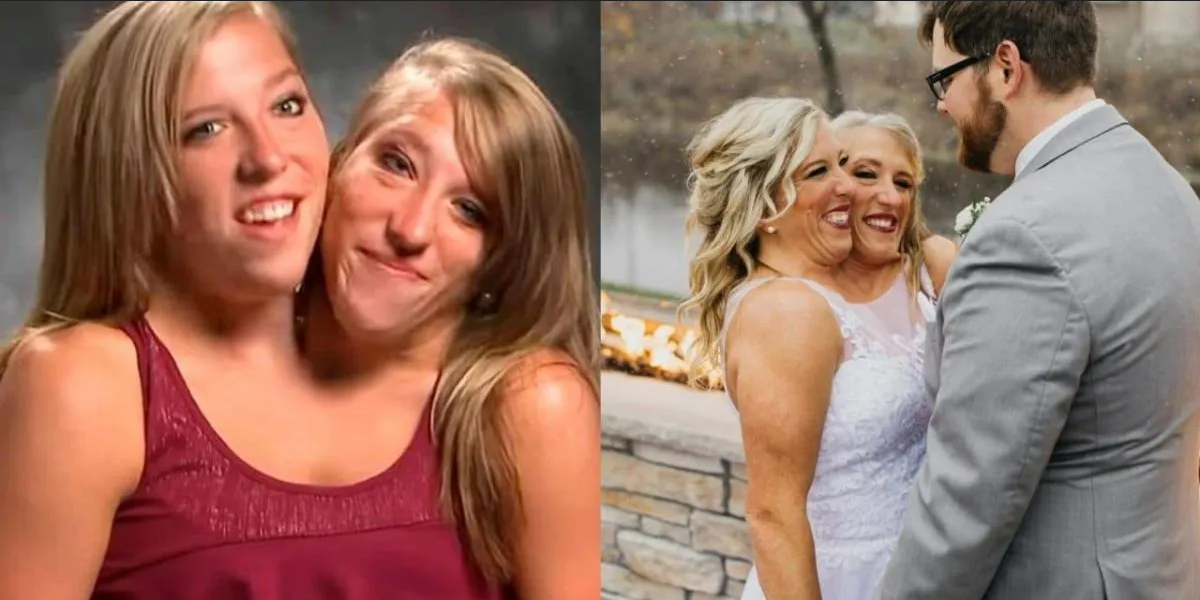 Gemela siamesa encuentra el amor y se casa, así fue la boda
