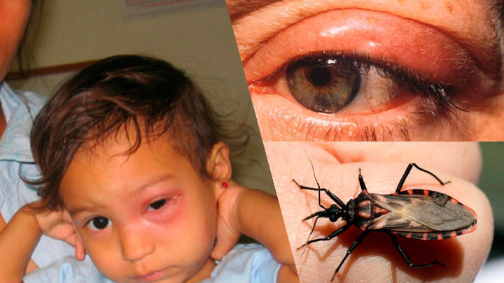 14 de abril: Día Mundial de la Enfermedad de Chagas