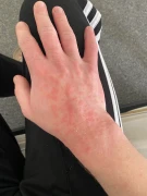 is it normal for the rash to look like this post treatment v0 7dj5j92ederg1