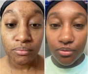 Before and After