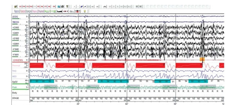 Polysomnography study showing sleep architecture and respiratory events in OSA