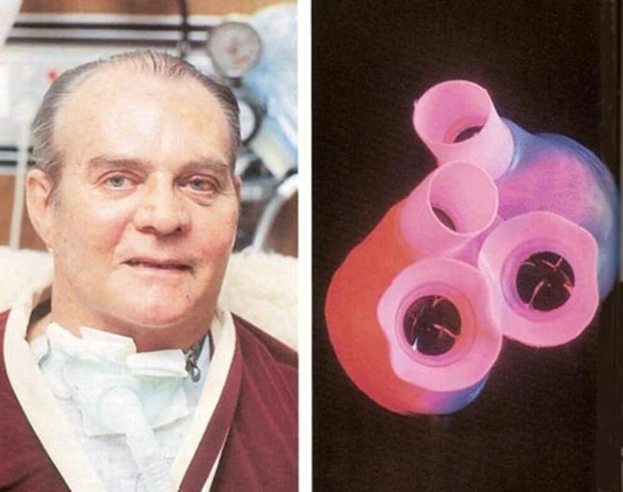 Первый пациент с искусственным сердцем (TAH – Total Artificial Heart) Барни Кларк Первый пациент с искусственным сердцем (TAH – Total Artificial Heart) Барни Кларк