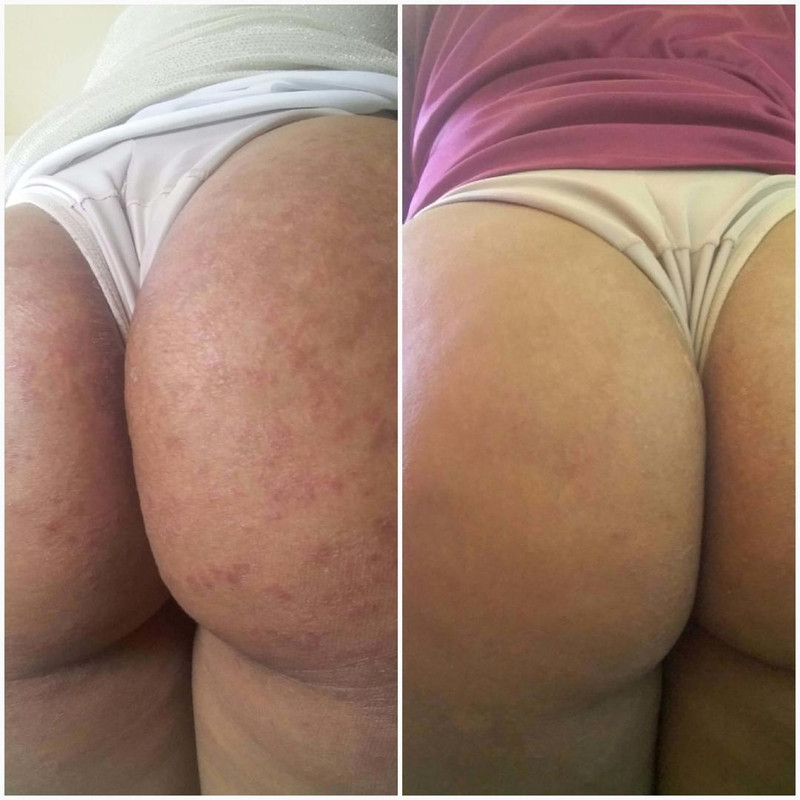 Resultado no bumbum