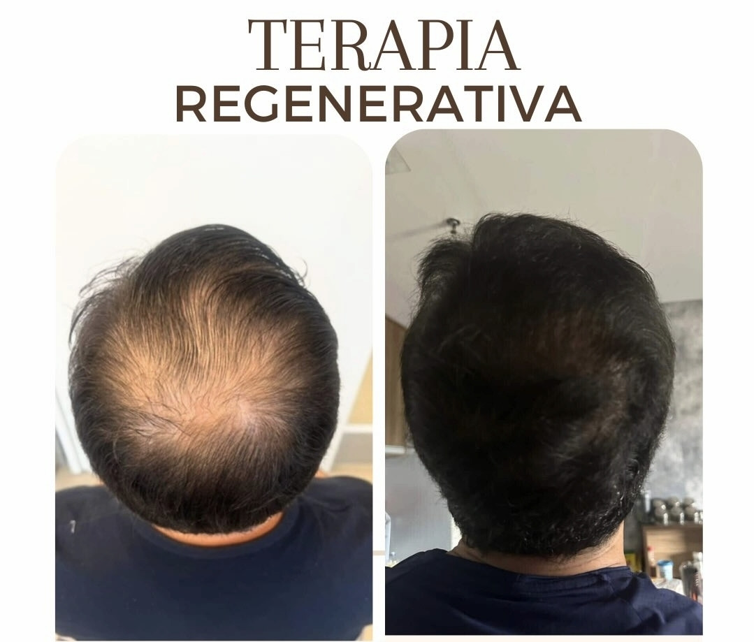Antes e depois da terapia regenerativa 1