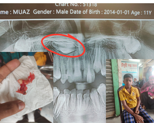 ১১ বছর বাচ্চার মাইনর সার্জারি