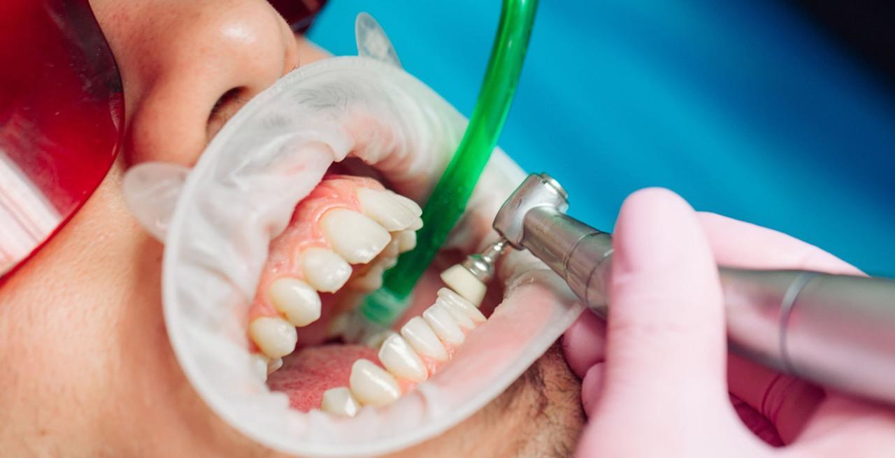 Is That High-Pitched Whine Worth It? Understanding Ultrasonic Teeth Cleaning in the Chair