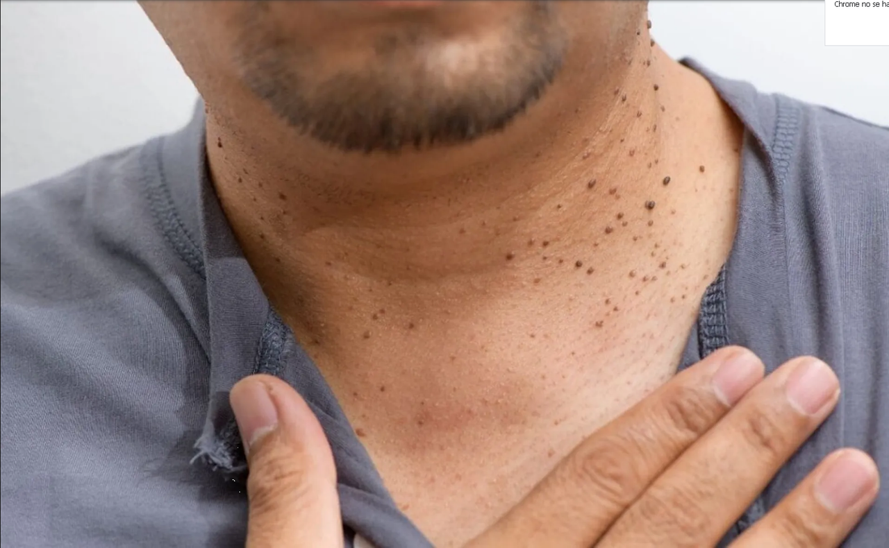 ¿Cómo eliminar las verrugas en el cuello rápidamente?