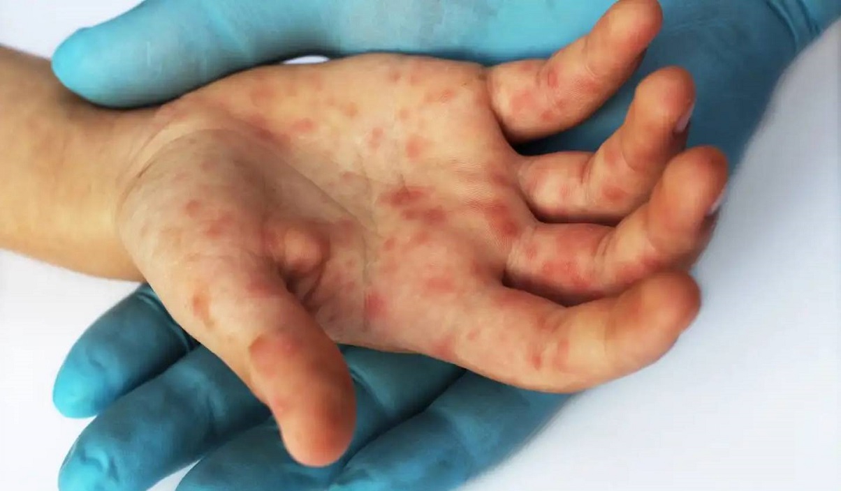 Viruela del mono: Portugal informa casos a medida que se propaga el brote