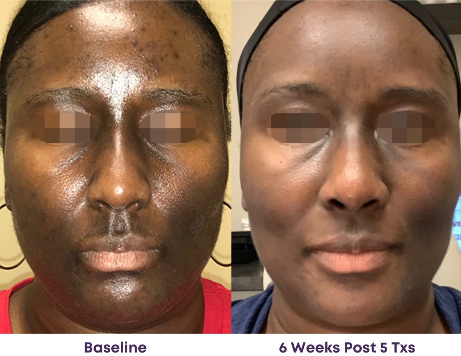 ClearLift before and after result at Let's Face It Med Spa in Denver.