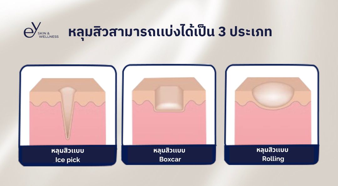 ey acne