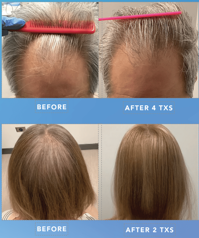 Alma TED treatment technology at Let's Face It Med Spa in Denver.