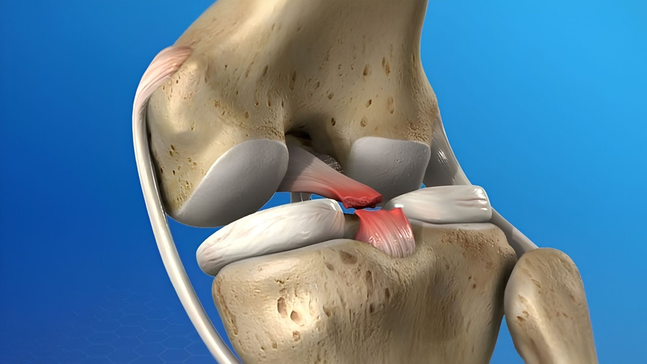 Minh họa giải phẫu 3D đứt dây chằng chéo trước tại khớp gối