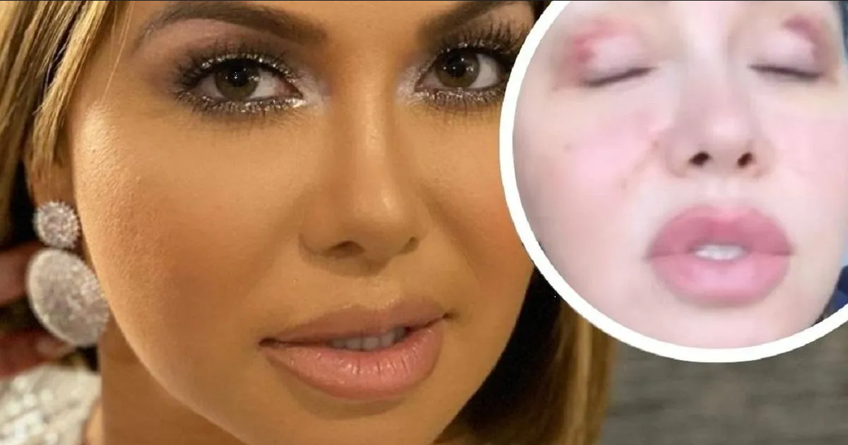 Chiquis Rivera preocupa al aparecer con la cara herida y llena de moretones