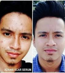 azanis scar serum ubat parut