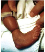 Amniotic band constricting the ankle - deep circumferential groove with distal edema and pseudosyndactyly