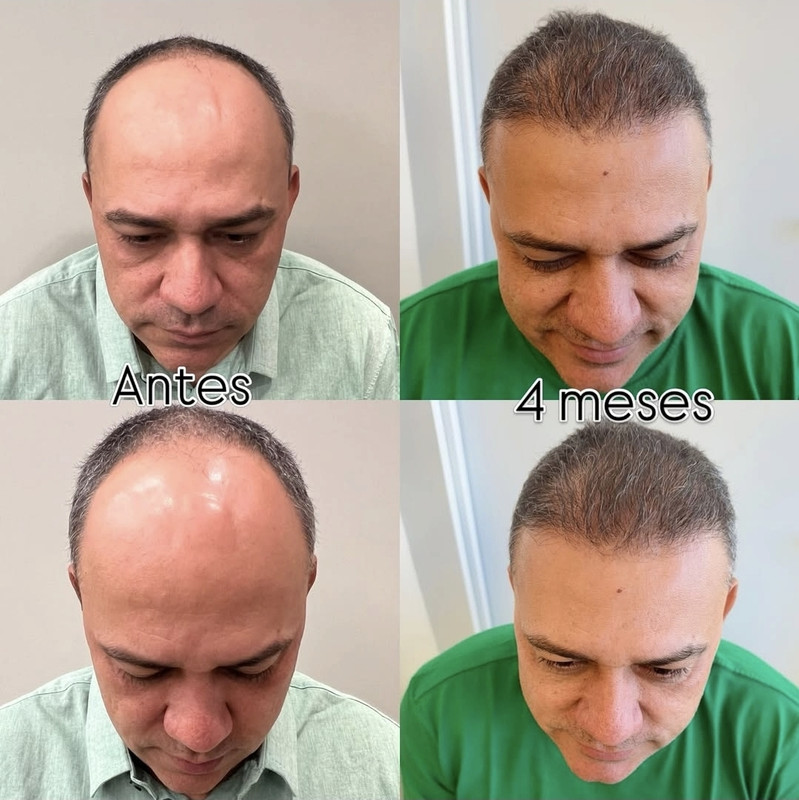 Resultado de transplante capilar 5