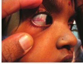 Clinical photograph showing dilated, tortuous blood vessels (telangiectasias) on the bulbar conjunctivae, characteristic of ataxia-telangiectasia