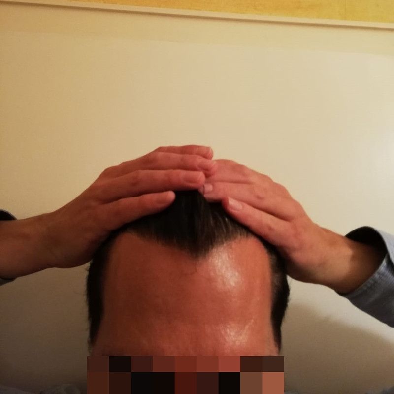 16 mesi 2001 grafts dense pack (2)