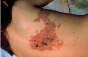 Unilateral, dermatomal vesicular rash of herpes zoster on the trunk